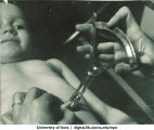 Measuring a child's body fat, The University of Iowa, 1930s